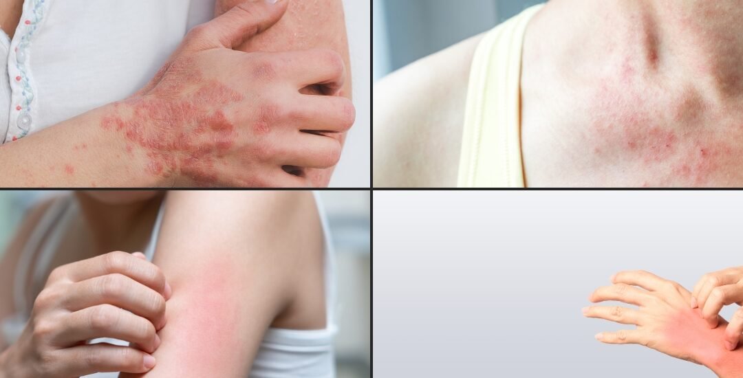Skin Rash from Amoxicillin: When to Worry and What to Do