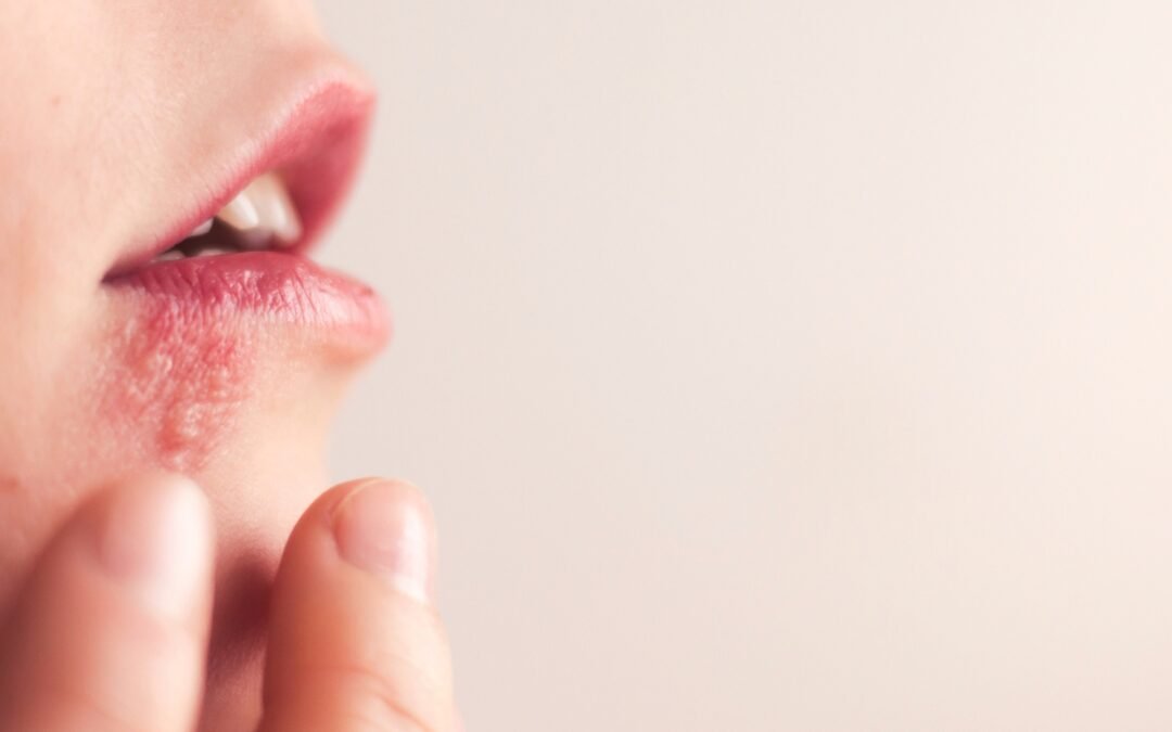What Does Herpes Look Like: How to Recognize the Signs Early