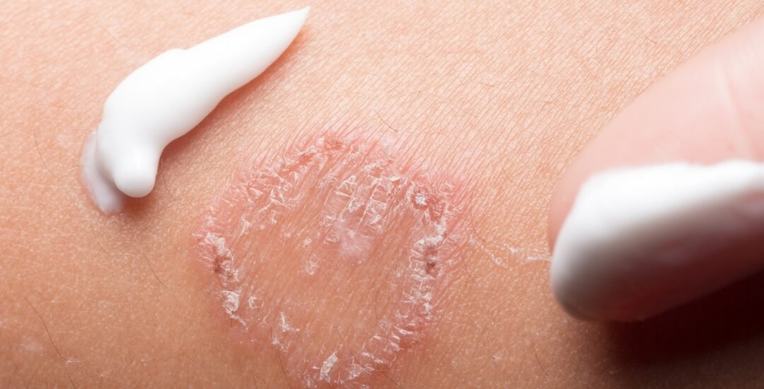 Antifungal Medicine for Ringworm: What You Should Know